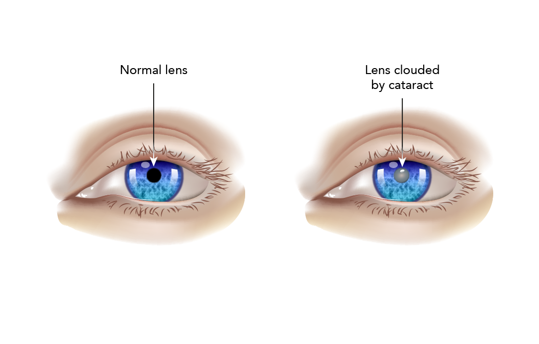 Cataracts and Cataract Surgery | My Doctor Online